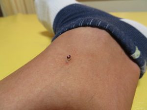 普通のお灸の火入れ