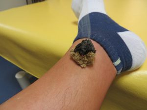 大きいお灸火入れサイズアップ