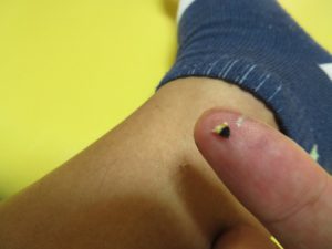 火を消した後のお灸