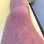【鍼灸師のリアル体験】膝がしらの下の痛みに自己鍼治療してみた結果