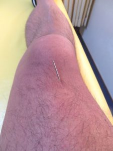 自己鍼治療（膝がしらの下が痛い）してみました